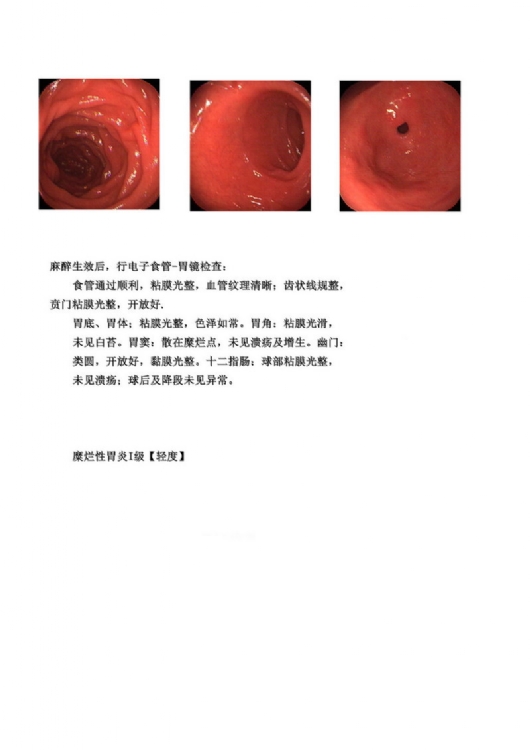 BƬ(CT-1)