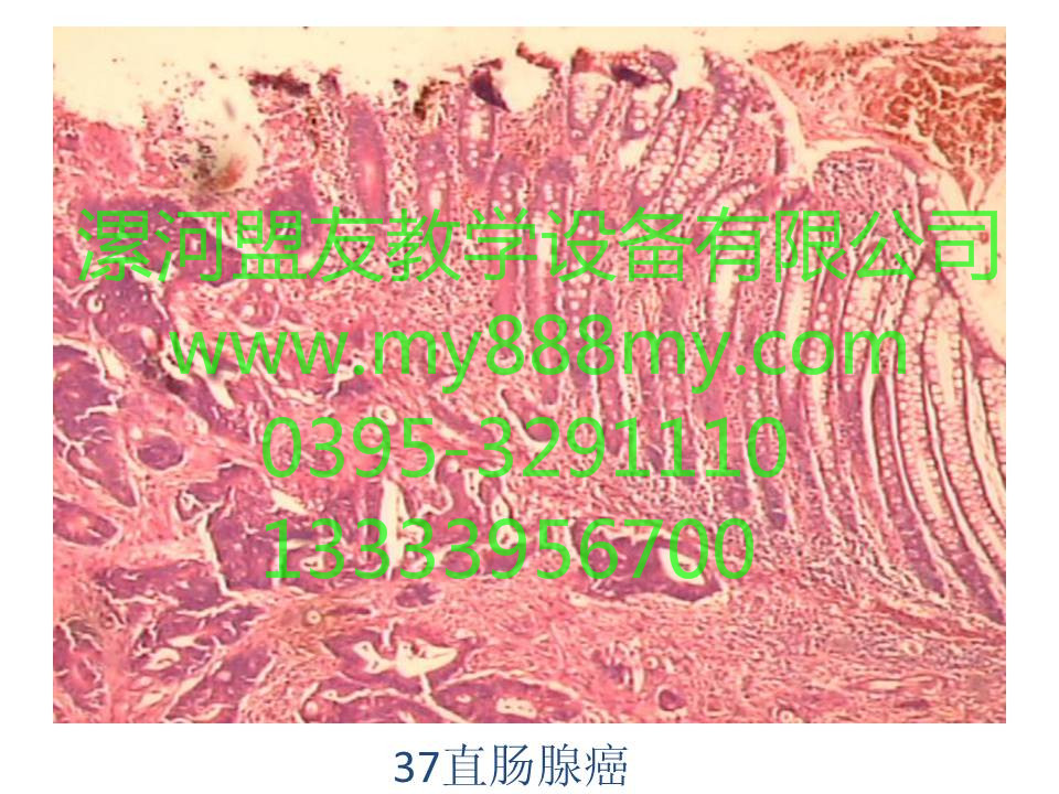 病理切片-图为直肠腺癌
